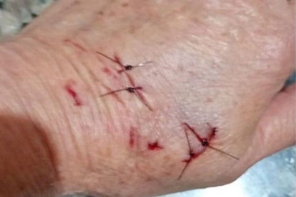  Mulher é atacada por dois pitbulls em Cabreúva