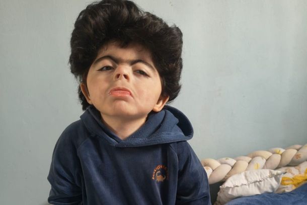 Vaquinha busca ajudar criança com síndrome rara na Região