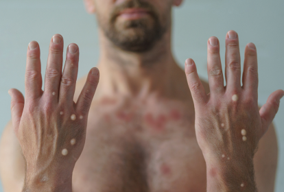 Jundiaí confirma segundo caso de mpox na RMJ